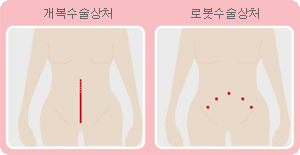 개볼 수설 상처와 로봇 수술 상처 비교
